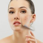 митове за акнето проблеми с акне митове съвети за акнето