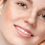 10 начина да се отървете от луничките по лицето бързо и естествено